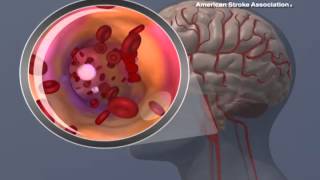 Transient Ischemic Attack TIA [upl. by Burny]