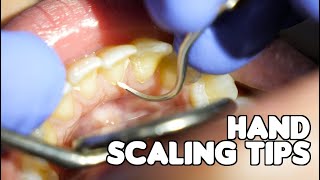 Dental Cleaning  Hand Scaling Tips [upl. by Peedus17]