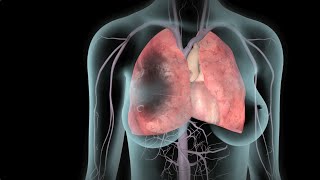 DVT and Pulmonary Embolism  Nucleus Health [upl. by Eibbed]