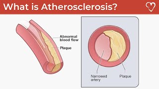 What is Atherosclerosis [upl. by Lrigybab]