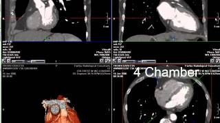 Coronary CT Angiography RCA Stenosis [upl. by Reiners]