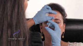 Botulinum Toxin  Injection Technique [upl. by Stefania]