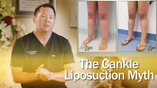 Lipedema Surgery  Cankle Liposuction  Expert Dr Thomas Su  ArtLipo [upl. by Rutan]