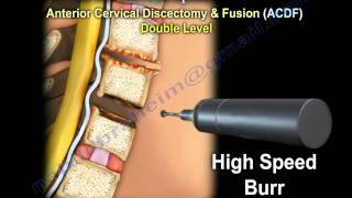 Cervical Spine Decompression And Fusion   Everything You Need To Know  Dr Nabil Ebraheim [upl. by Sudhir]