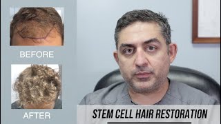 Stem Cell Hair Restoration Success Story [upl. by Krik]