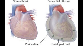 Derrame pericardico é grave Quais são as causas [upl. by Oster872]