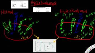 Hyperkalemia  The effects of hyperkalemia on resting membrane potential  depolarized  why amp how [upl. by Hazaki]