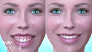 Le Fort I  Gummy Smile amp Upper Jaw Reduction [upl. by Edia852]