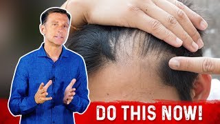 Receding Hairline Causes And Remedies – DrBerg [upl. by Ydarb]