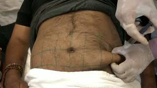 Lipodissolve Injection Technique for PeriAbdominal Fat  ILAMED [upl. by Garald943]