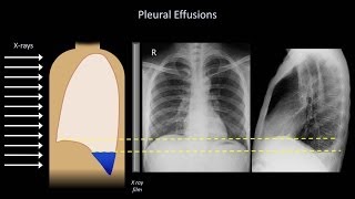 How to Interpret a Chest XRay Lesson 6  Diaphragm and Pleura [upl. by Iaj]