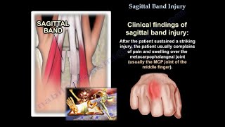 Sagittal Band Injury  Everything You Need To Know  Dr Nabil Ebraheim [upl. by Budge]