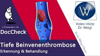 Tiefe Beinvenenthrombose TVT Die Gefahr des Übersehens  Thrombose oder Muskelzerrung DocCheck 3 [upl. by Heidt]