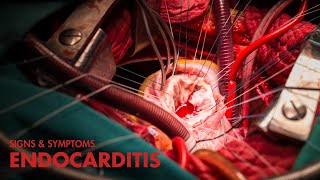 Signs and Symptoms of Endocarditis Mnemonic [upl. by Annayad921]