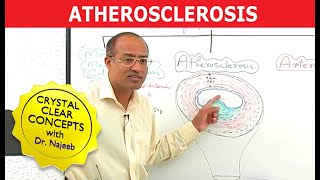 Atherosclerosis  Pathophysiology [upl. by Iffar472]