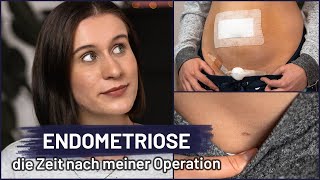 Nach meiner Endometriose Operation  Laparoskopie  Bauchspiegelung  OP Nachsorge Heilung amp Narben [upl. by Seigel]