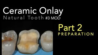 Lithium Disilicate Ceramics Part 2 Ceramic Onlay Preparation [upl. by Benge]