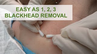 Easy as 1 2 3 Blackhead Removal  Dr Derm [upl. by Marva]