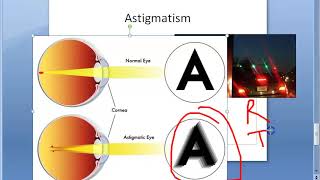 Ophthalmology 044 a Refractive Errors Of Refraction Emmetropia Ametropia Myopia HyperMetropia Eye [upl. by Riamu]